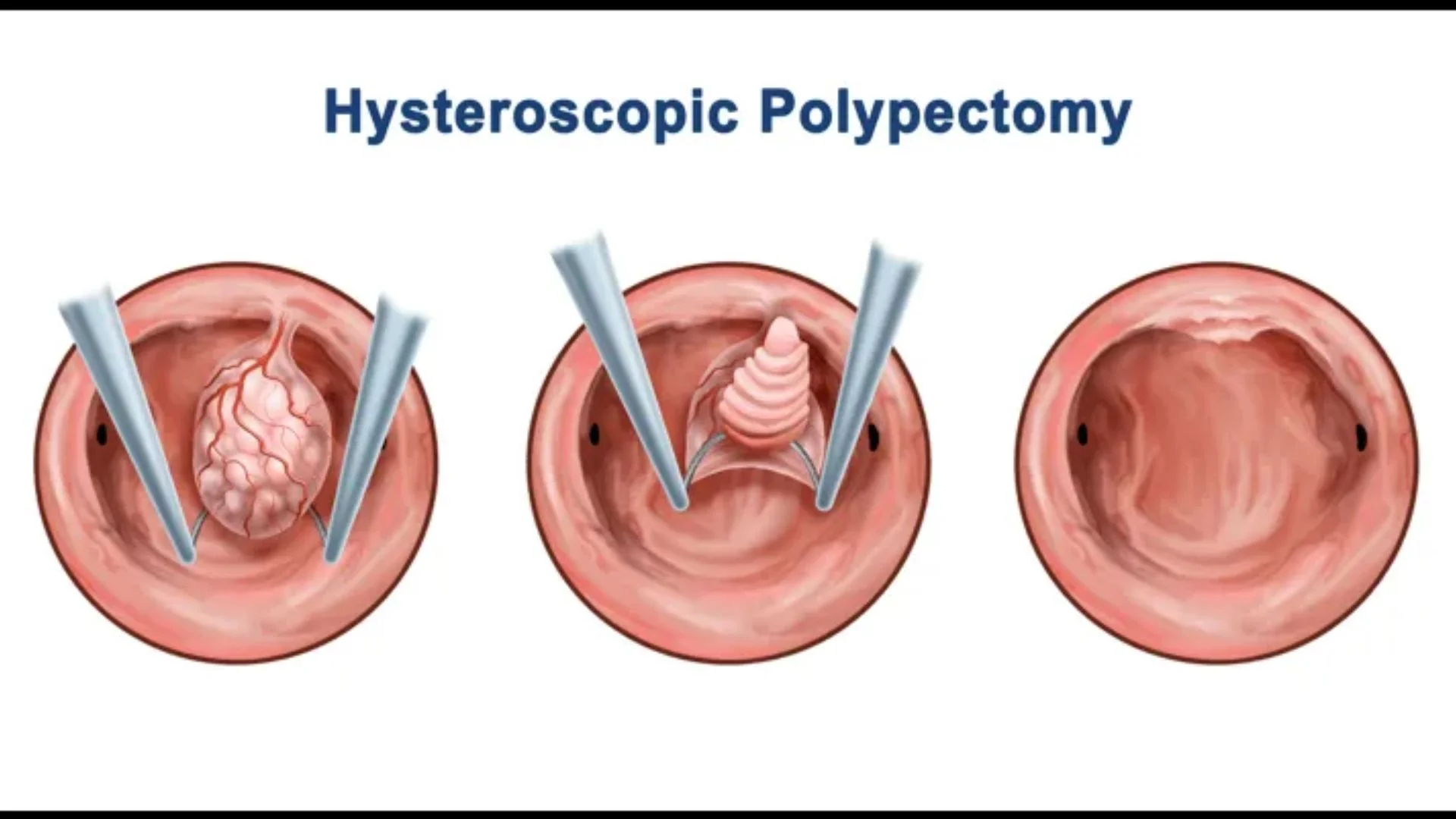 Operative Hysteroscopy