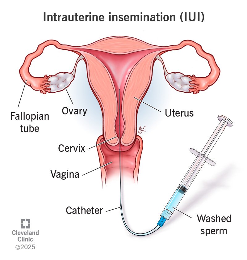 IUI Treatment
