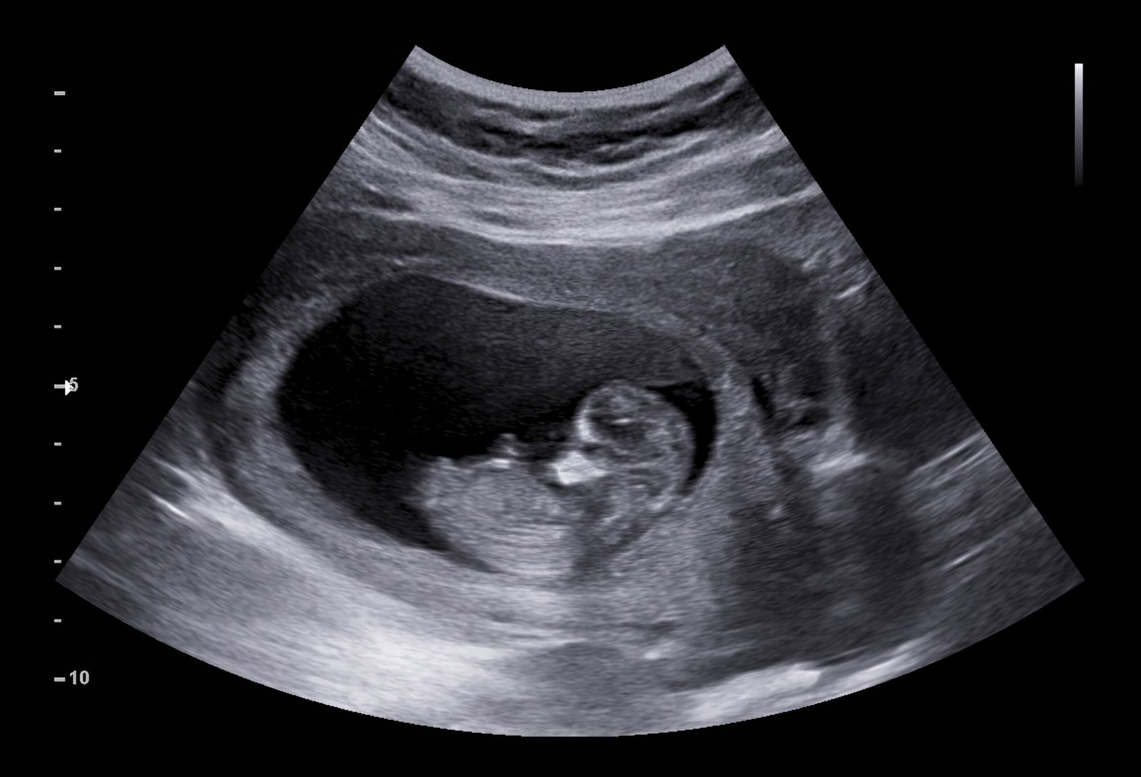 USG Pregnancy